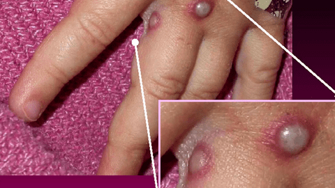 Mức độ nguy hiểm của bệnh đậu mùa khỉ
