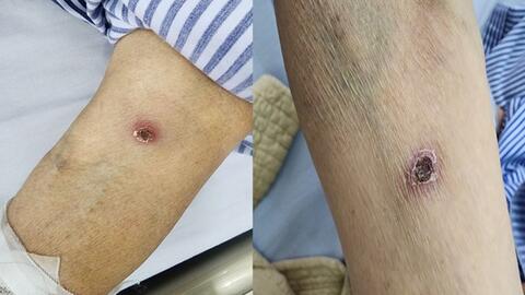 Sốt mò ở bệnh nhân đái tháo đường có thể gây biến chứng