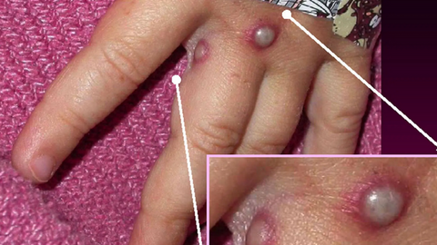 Mức độ nguy hiểm của bệnh đậu mùa khỉ